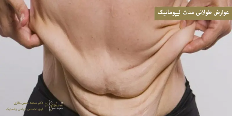 عوارض-طولانی-مدت-لیپوماتیک