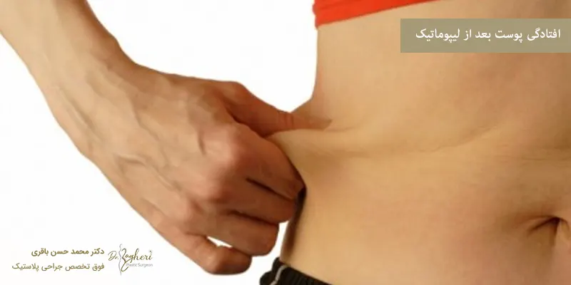 افتادگی پوست بعد از لیپوماتیک