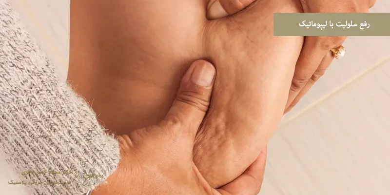 رفع سلولیت با لیپوماتیک