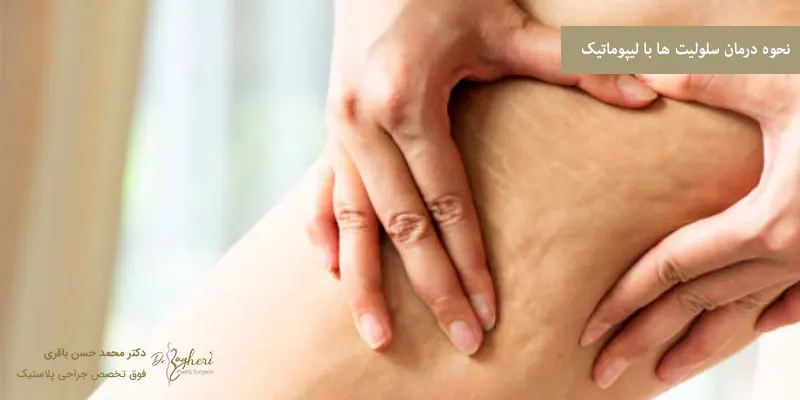 نحوه درمان سلولیت ها با لیپوماتیک