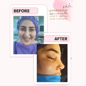 رینوپلاستی نمونه کار
